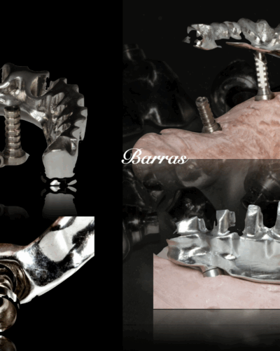 ESTRUCTURAS SOBRE IMPLANTES