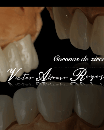 CORONA EN ZIRCONIO