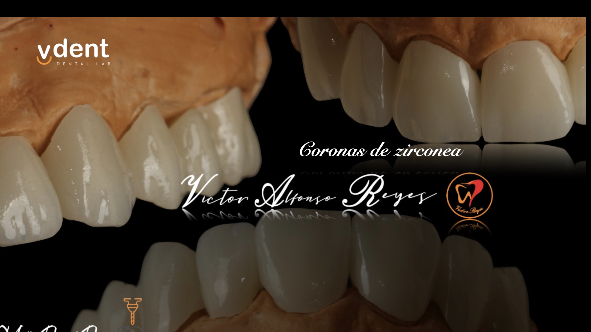 CORONA EN ZIRCONIO