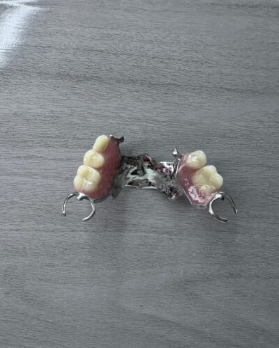 PROTESIS CON ESTRUCTURA METALICA